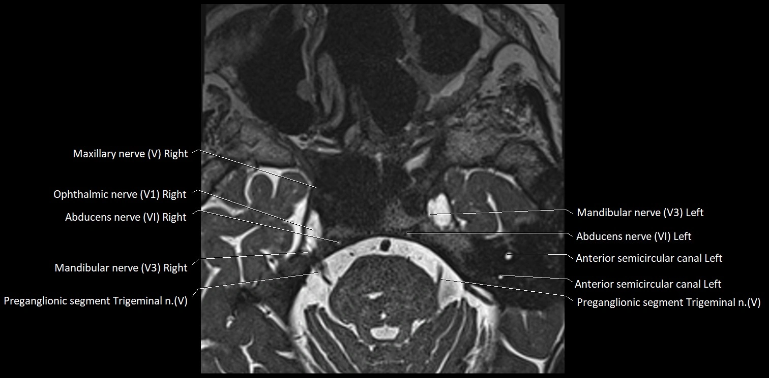 Cranial nerve anatomy axial MRI 3T image 43.webp